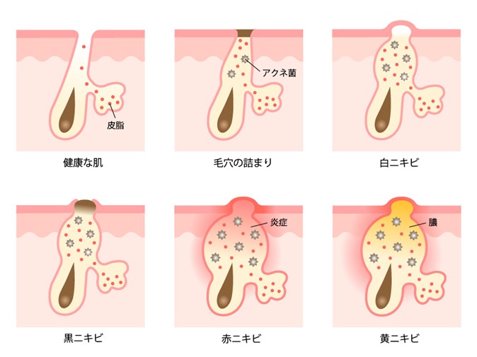 ニキビの原因