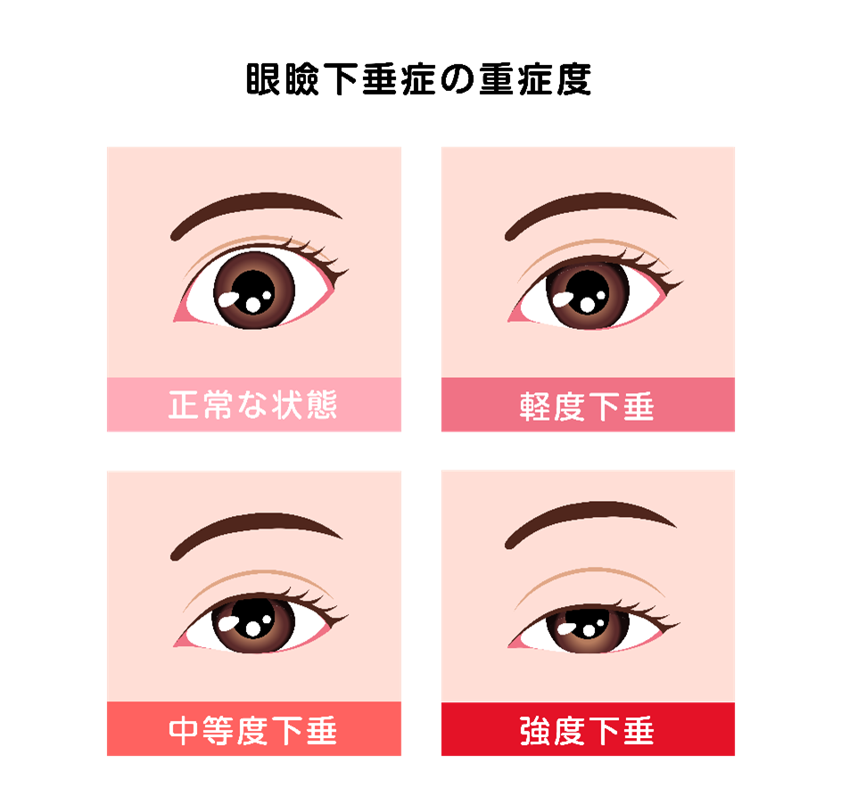 眼瞼下垂とはどのような症状なの？