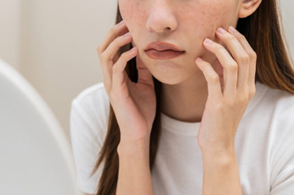 シミ治療のイメージ写真