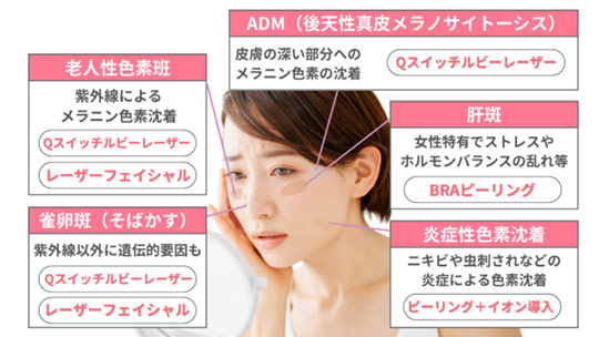 シミ治療のイメージ写真