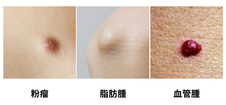 真皮・皮下組織のできもの